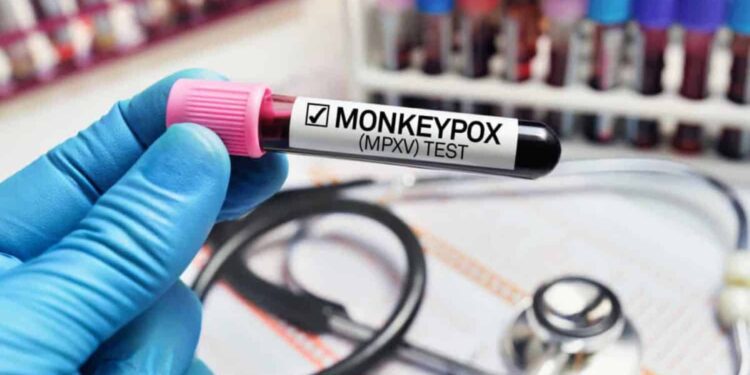 Monkeypox update: Man with travel history to Peru, one of two new cases