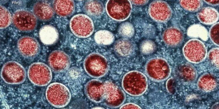 Rise in mpox cases is 'super concerning,' doctor says