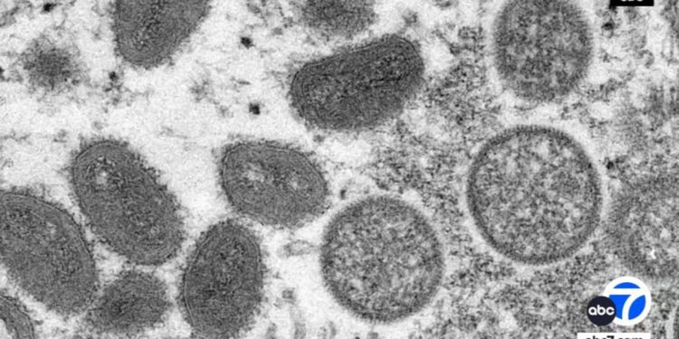 United States' first known case of more severe strain of mpox is confirmed in California