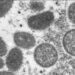 United States' first known case of more severe strain of mpox is confirmed in California