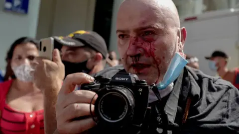 Getty Images AP photographer, Spanish Ramon Espinosa, is seen with injuries in his face