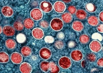 United States’ first known case of more severe strain of mpox confirmed in California