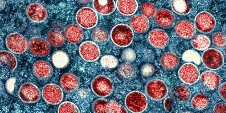 United States’ first known case of more severe strain of mpox confirmed in California