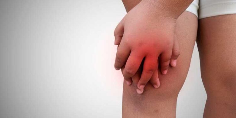 ‘Walk to Cure Juvenile Arthritis’ at Mall of America on April 26 – kare11.com