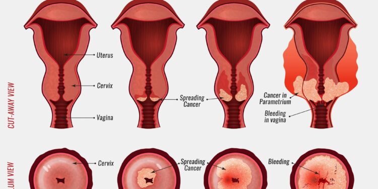 Unite to End Cervical Cancer: A Bold Plan to Save 30,000 Lives Every Year in Latin America and the Caribbean!